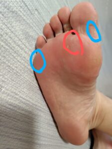 足裏の状態